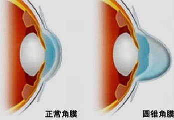 圓錐角膜，哪種角膜移植術(shù)好？